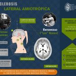 Esclerosis Lateral ELA - Stephen Hawking